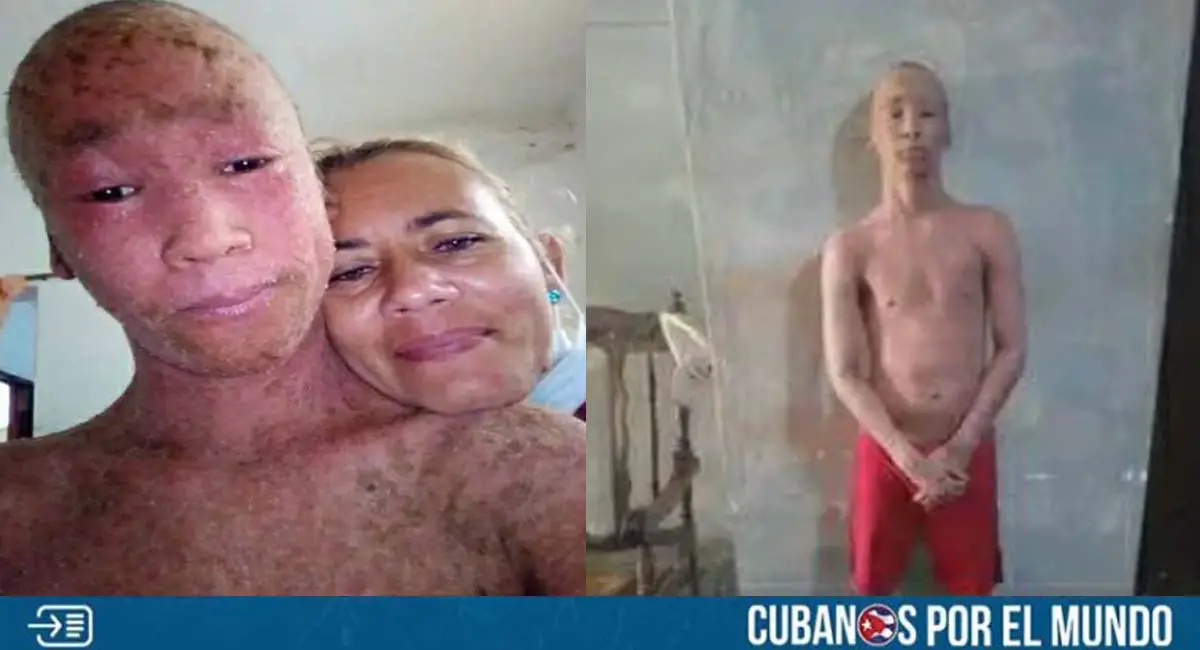 Piden ayuda para joven cubano de Sancti Spíritus con rara enfermedad en la piel