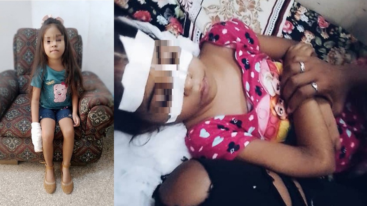 Piden ayuda para niña cubana con malformación arteriovenosa