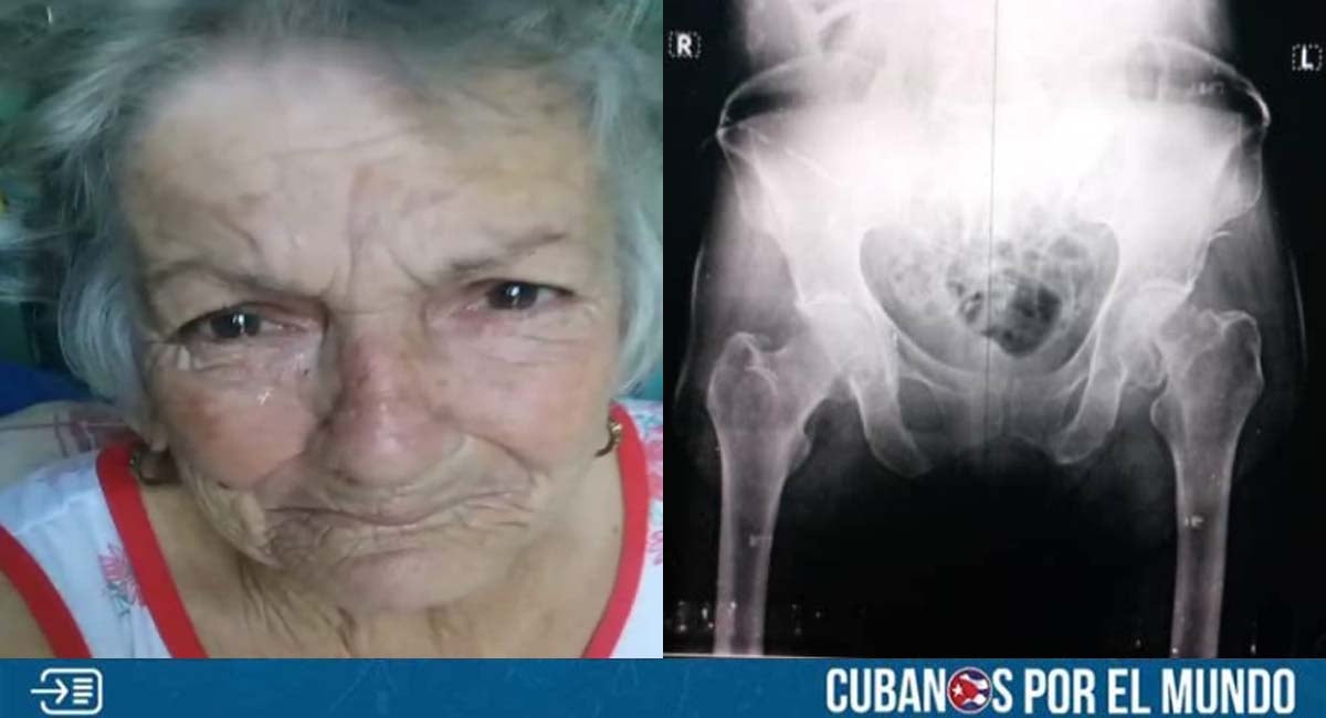 Cubana pide ayuda con una prótesis para su madre: “Sufre desesperadamente”