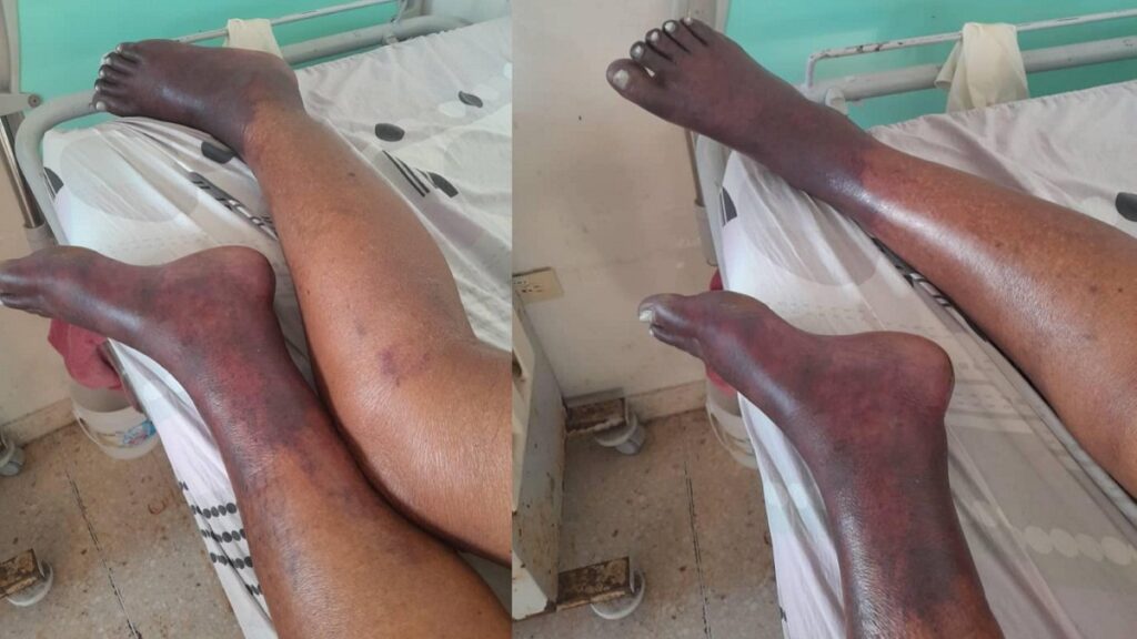 Pacientes diabéticos en el hospital "La Benéfica" están condenados a una muerte lenta y dolorosa