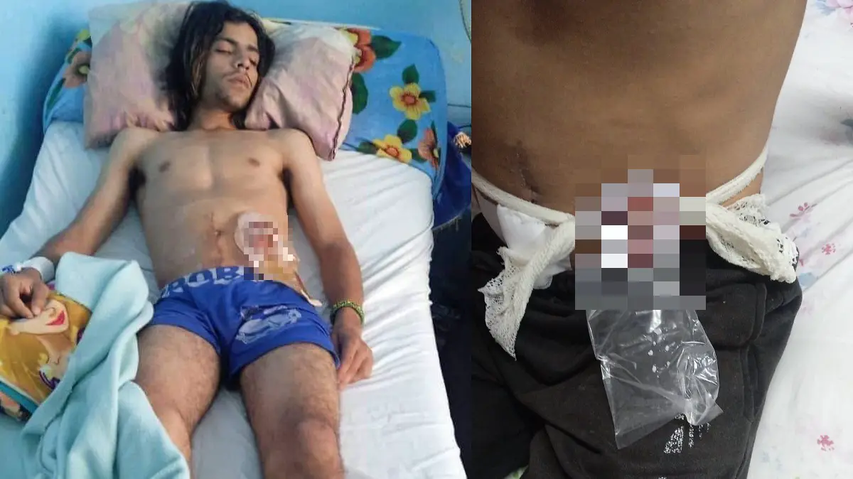 Piden ayuda para joven cubano con colostomía