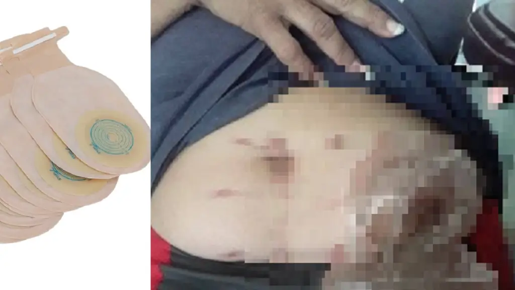 Piden ayuda para una cubana operada de colostomía