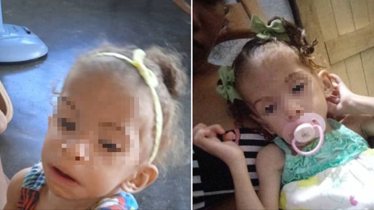 Piden ayuda para niña cubana con microcefalia y desnutrición