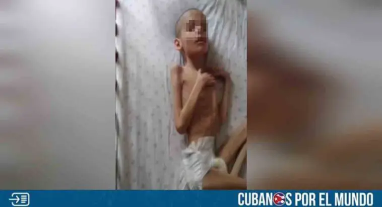 Niño con desnutrición severa en Sancti Spíritus requiere ayuda urgente