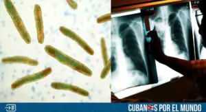 Alarma en Florida por casos de tuberculosis (+VIDEO)