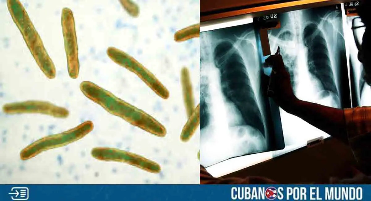 Alarma en Florida por casos de tuberculosis