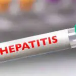 Brote de hepatitis genera preocupación en Matanzas