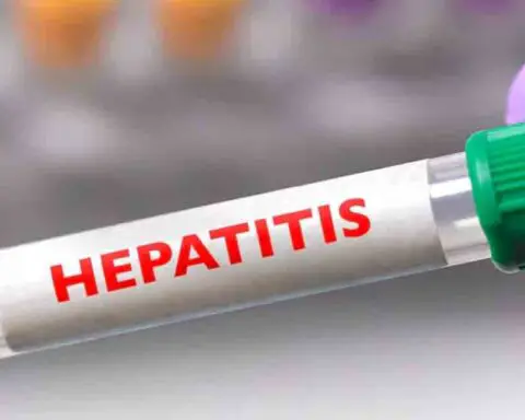 Brote de hepatitis genera preocupación en Matanzas