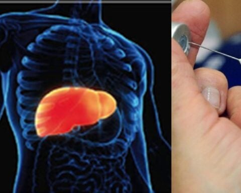 Embajada de EE.UU. emite alerta sanitaria por aumento de Hepatitis A en La Habana